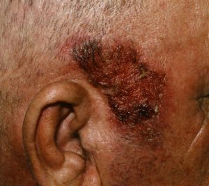 Autoimmune Disease - Pemphigus Vulgaris on scalp