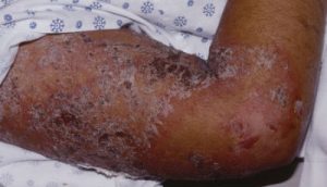 Autoimmune Disease - Pemphigus Foliaceous on arm