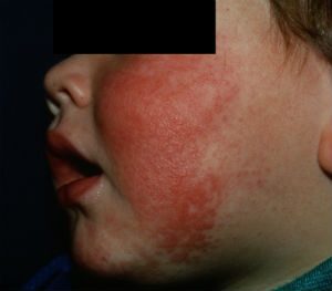 Should I Worry About My Child's Rash? - The Derm Centers